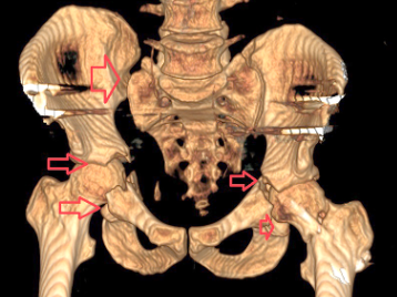 Leğen Kemiği Parçalanan Hasta Sağlığına Kavuştu
