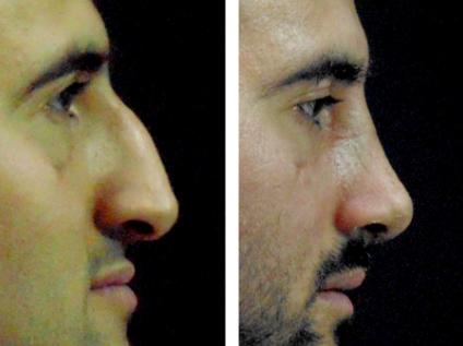 Komşu Ülkeden Gelen Hastanın Burnundaki Rahatsızlık Giderildi